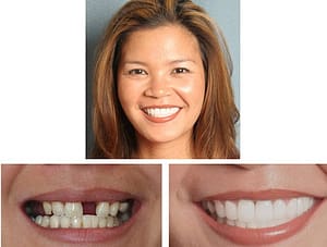 Cosmetic Dentist Glen Ellyn--Lumineers Wheaton IL patient