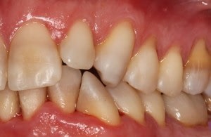 Signs of gum disease