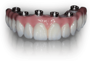 Teeth Tomorrow Implant Bridge