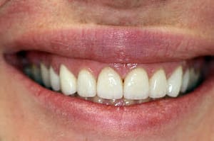 Gummy smile-Gum lift-Porcelain veneers--Wheaton patient