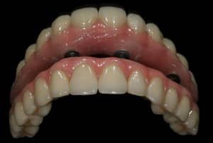 Dental Implant Bridge--Replace Denture Glen Ellyn