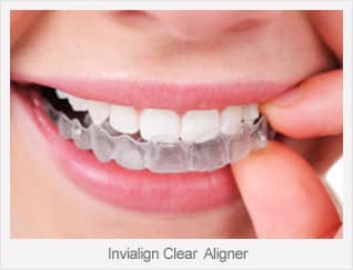 Glen Ellyn, Wheaton, Glendale Heights Invisalign Dentist
