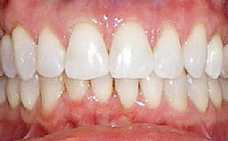 Teeth Whitening With Invisalign
