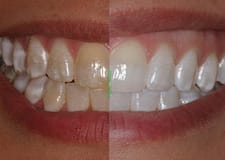 Tooth Whitening Glen Ellyn IL