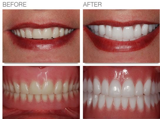 Cosmetic-Denture, Facelift denture