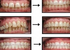 Best Invisalign Results