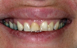 Gummy smile-Gum lift-Porcelain veneers--Wheaton patient