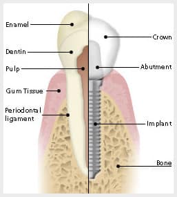 dentalimplants