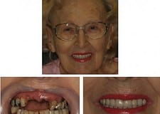 Dental Implant Bridge Full Crowns