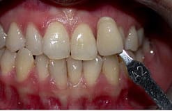 Tooth Whitening Glen Ellyn