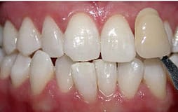 Tooth Whitening IL