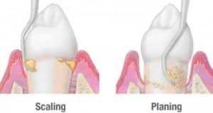 root planning gum disease
