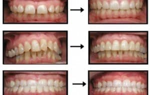 Invisalign Invisline Braces – Gentle Family Dentistry