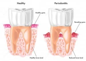 periodontitis, bone loss glen ellyn