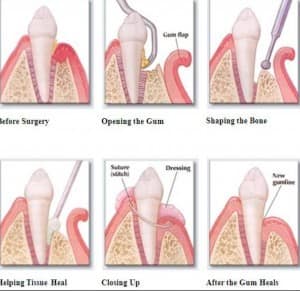 periodontitis treatment cures