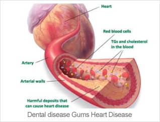 Dental Health Heart Disease