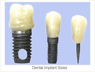 implant-sizes