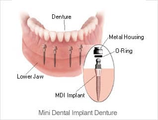 mini-implants