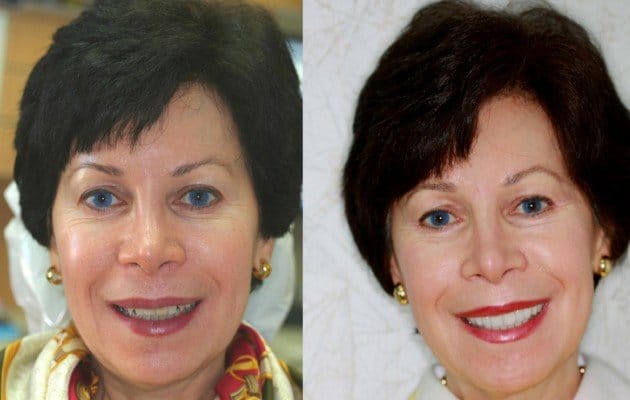 Lumineers – Cosmetic Dentist Wheaton Before-After